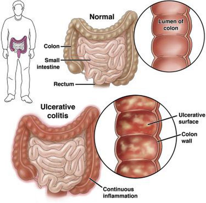 Ulcerative colitis is a long-term condition where Symptoms of ulcerative colitis

The main symptoms of ulcerative colitis are:

recurring diarrhoea, which may contain blood, mucus or pus
tummy pain
needing to empty your bowels frequently
You may also experience extreme tiredness (fatigue), loss of appetite and weight loss.

The severity of the symptoms varies, depending on how much of the rectum and colon is inflamed and how severe the inflammation is.

For some people, the condition has a significant impact on their everyday lives.

Symptoms of a flare-up

Some people may go for weeks or months with very mild symptoms, or none at all (remission), followed by periods where the symptoms are particularly troublesome (flare-ups or relapses).

During a flare-up, some people with ulcerative colitis also experience symptoms elsewhere in their body.

For example, some people develop:

painful and swollen joints (arthritis)
mouth ulcers
areas of painful, red and swollen skin
irritated and red eyes
In severe cases, defined as having to empty your bowels 6 or more times a day, additional symptoms may include:

shortness of breath
a fast or irregular heartbeat
a high temperature (fever)
blood in your stools becoming more obvious
In most people, no specific trigger for flare-ups is identified, although a gut infection can occasionally be the cause.

Stress is also thought to be a potential facto the colon and rectum become inflamed.