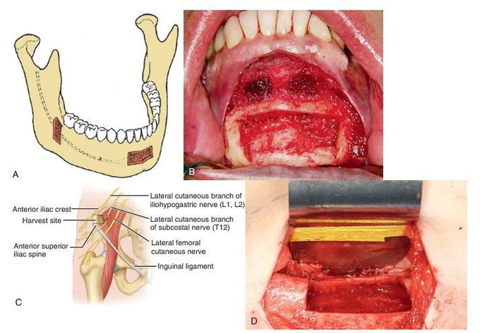 Sites of autogenous bone graft harvest