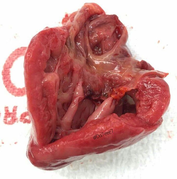 Neonatal Heart