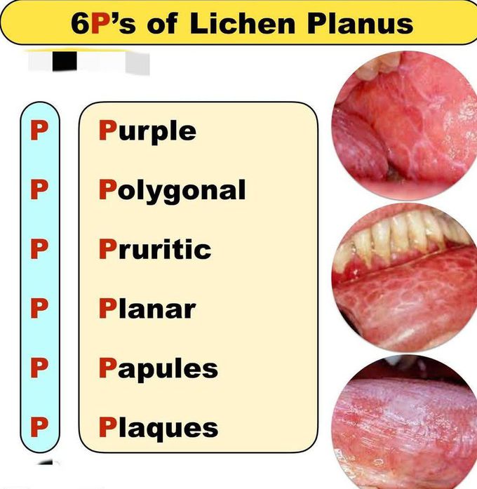 6P's of Lichen Planus
