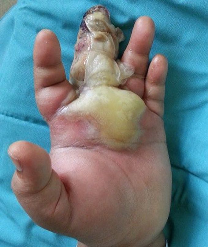 Case of a diabetic patient with left middle finger infection with abscess formation, requiring Ray's amputation