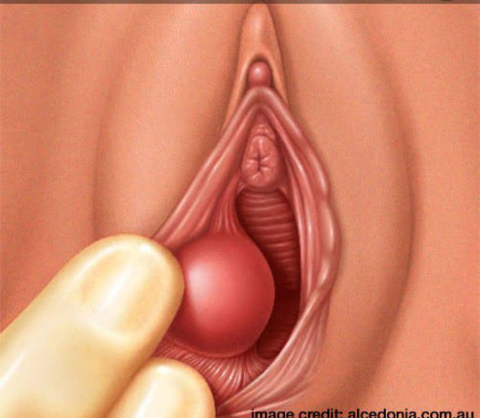 Bartholin's cyst