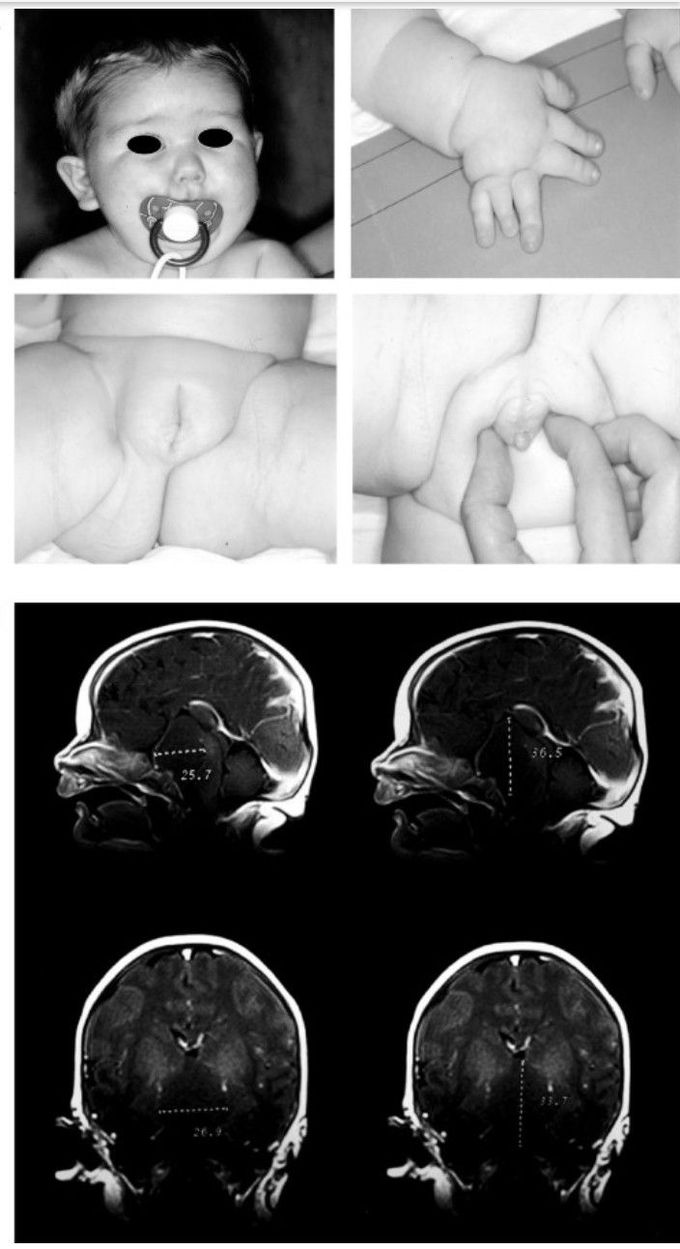 Pallister-Hall Syndrome: Presentation and Prognosis