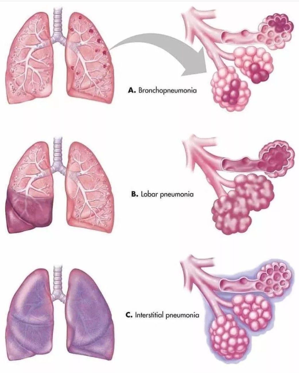 Types of Pneumonia - MEDizzy