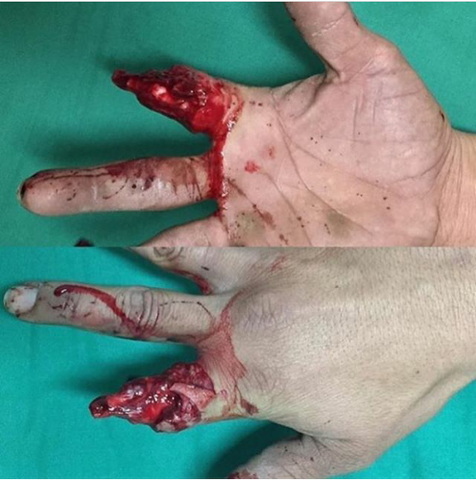 Degloving injury and avulsion fracture of phalanx