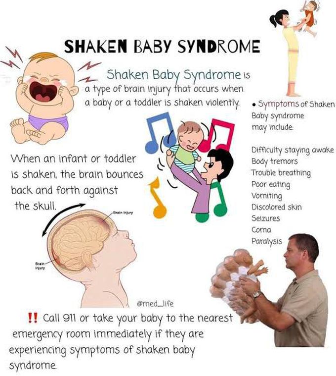 Symptoms of shaken baby syndrome