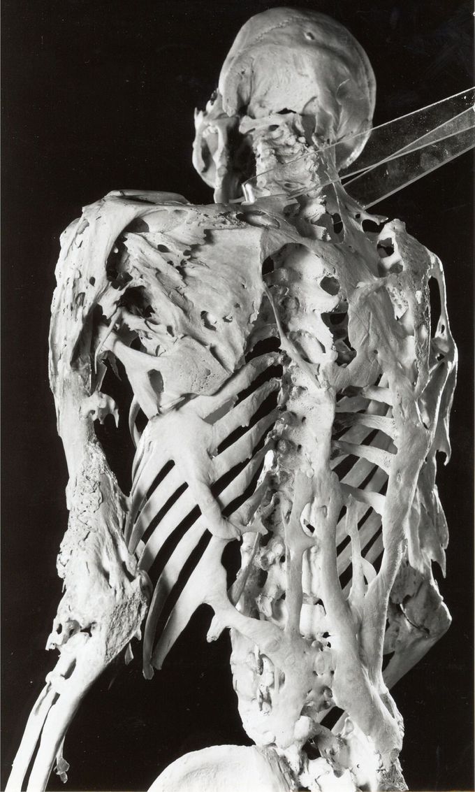 Fibrodysplasia Ossificans Progressiva (FOP)