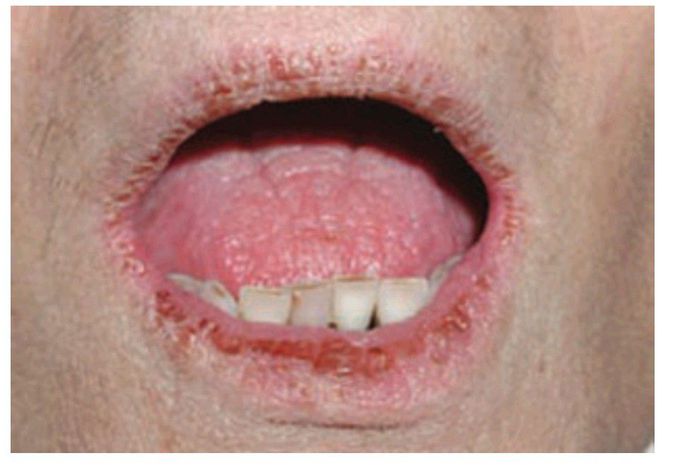 Dry mouth : cheilitis