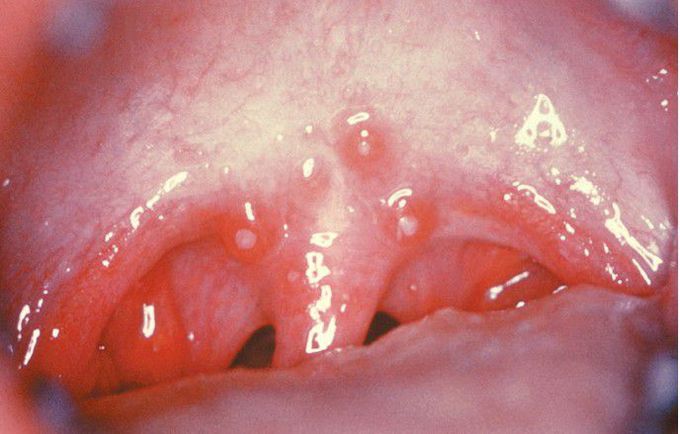 Acute Lymphonodular Pharyngitis.