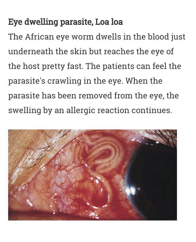 Parasite on eyes