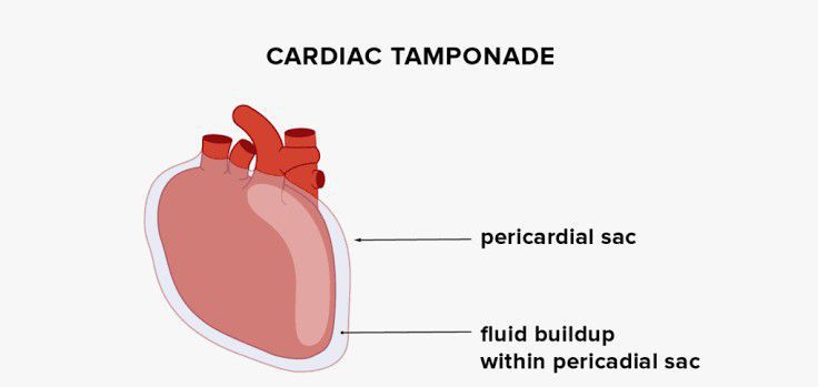 Cardiac Temponade Medizzy