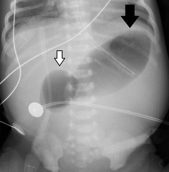 "Double Bubble" Sign in a patient with Duodenal Atresia