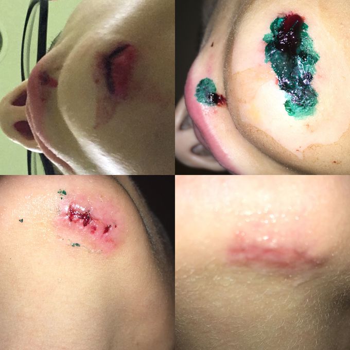 Lower chin injury