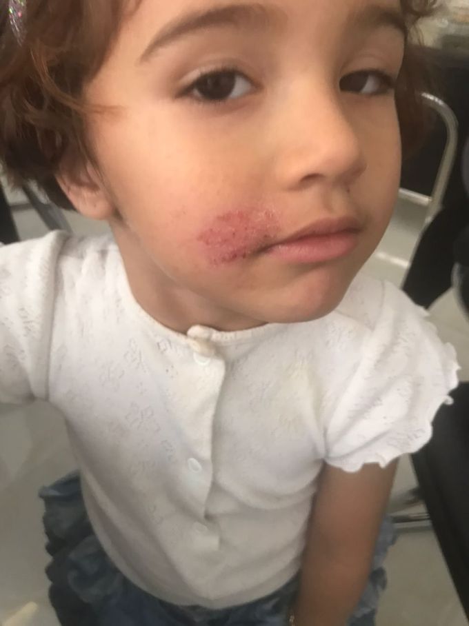 Tinea facies