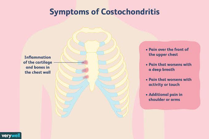 Costochondritis