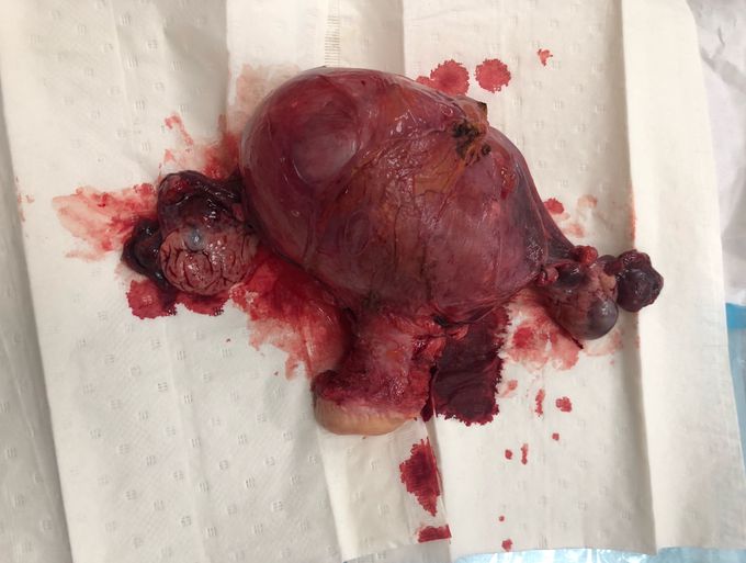 Uterus with tumor