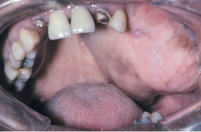 Fibrous Dysplasia.