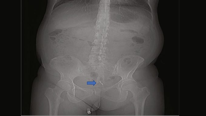 IUD ends up in woman's bladder