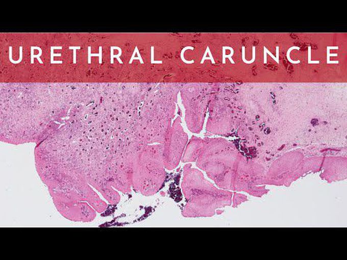 Urethral Caruncle