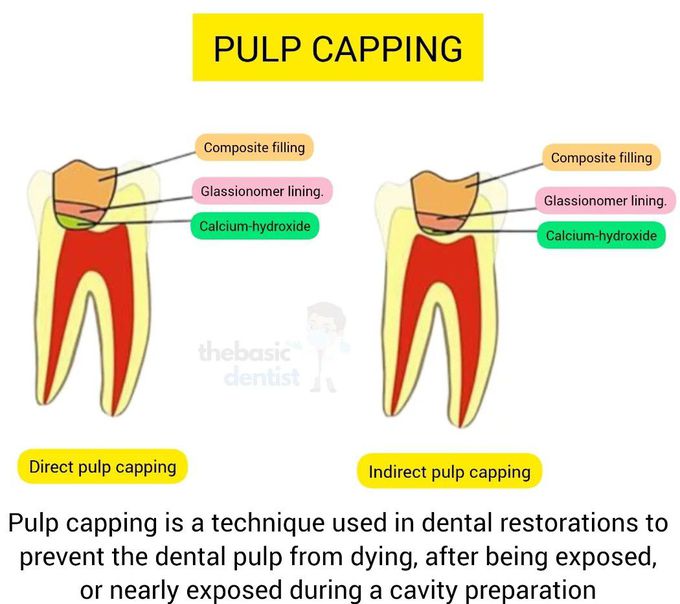 Pulp Capping I