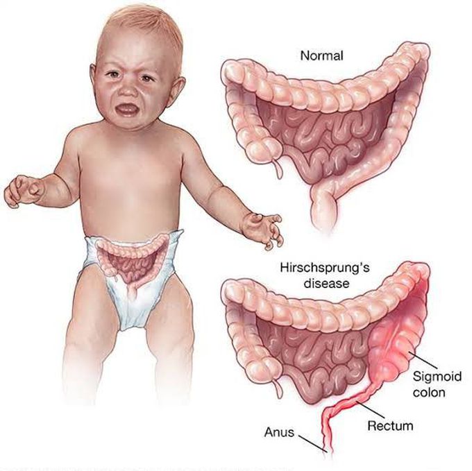 What is Hirschsprung disease?