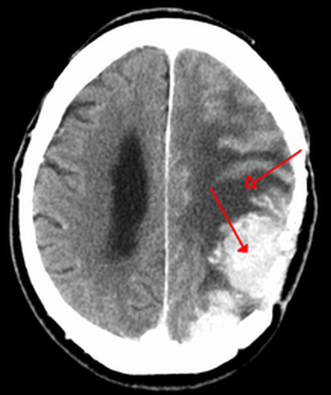 Meningioma- Radiology