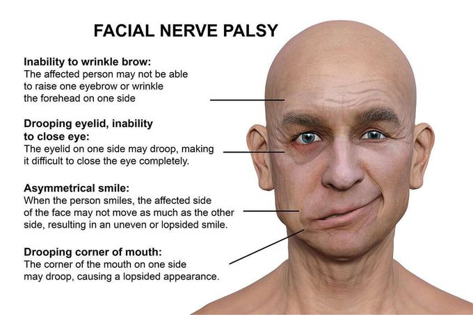 Symptoms of bell's palsy