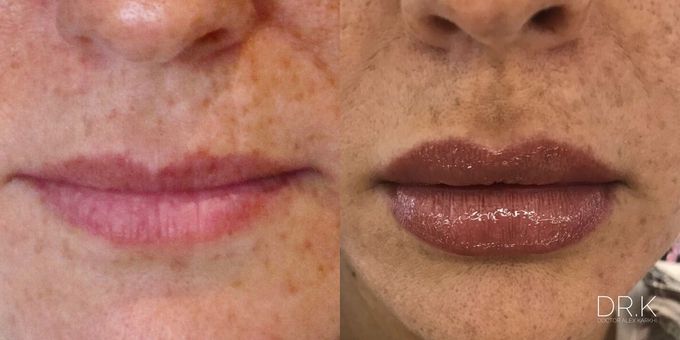 Lips enhancement