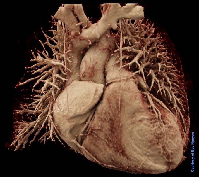 Whole Heart MRI