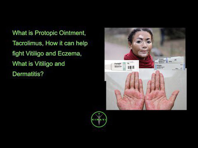 Tacrolimus for Vitiligo and Eczema
