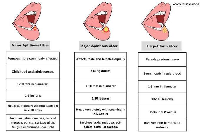 Oral Ulcers