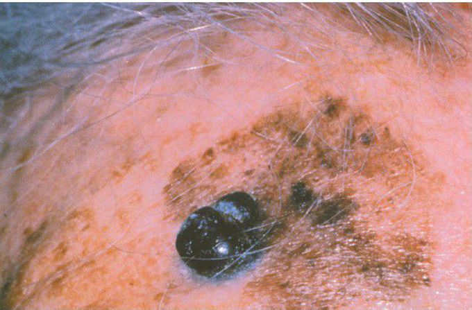 Lentigo Maligna Melanoma