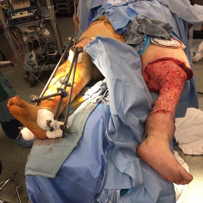 Charles procedure