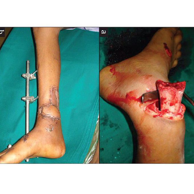 Open fracture dislocation