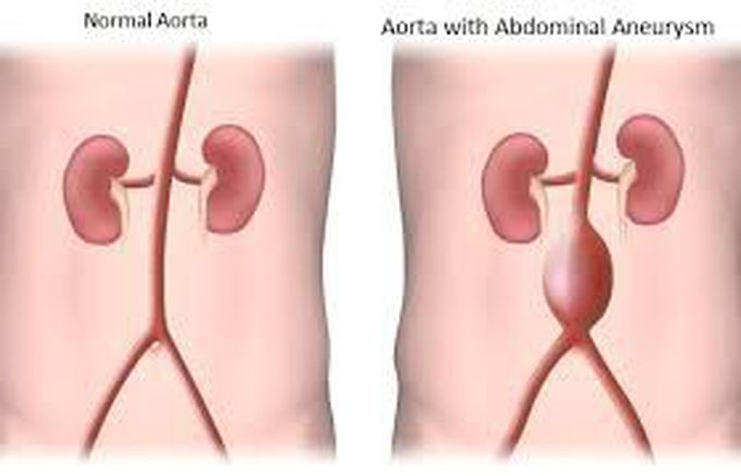 Abdominal aortic aneurysm