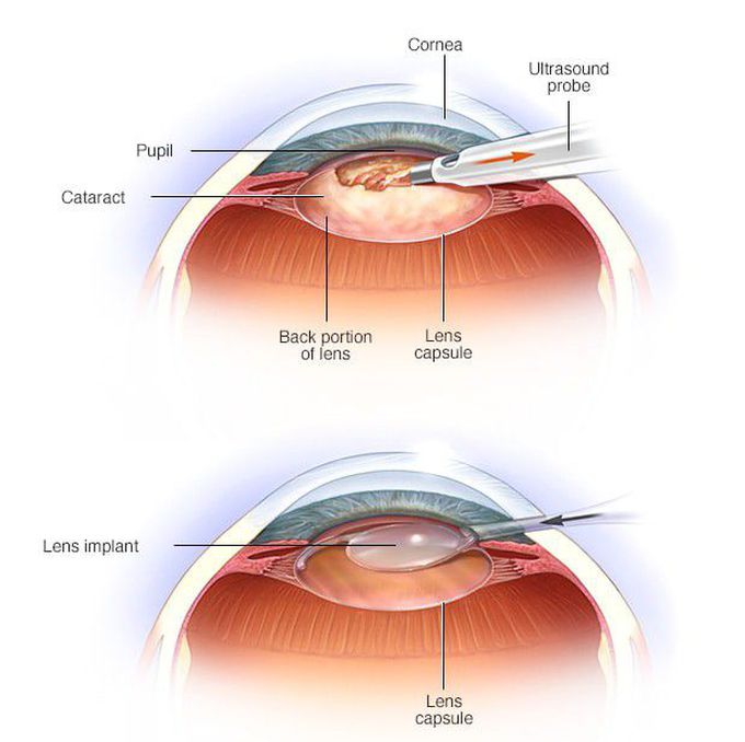 Treatment for Cataract