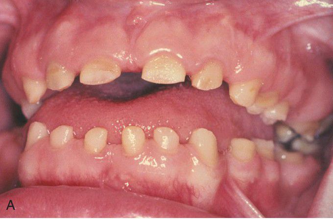 Hypoplastic Amelogenesis Imperfecta, Rough Pattern (Generalized Thin Pattern). 