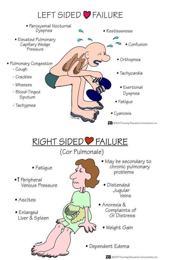 Symptoms Of Heart Failure MEDizzy
