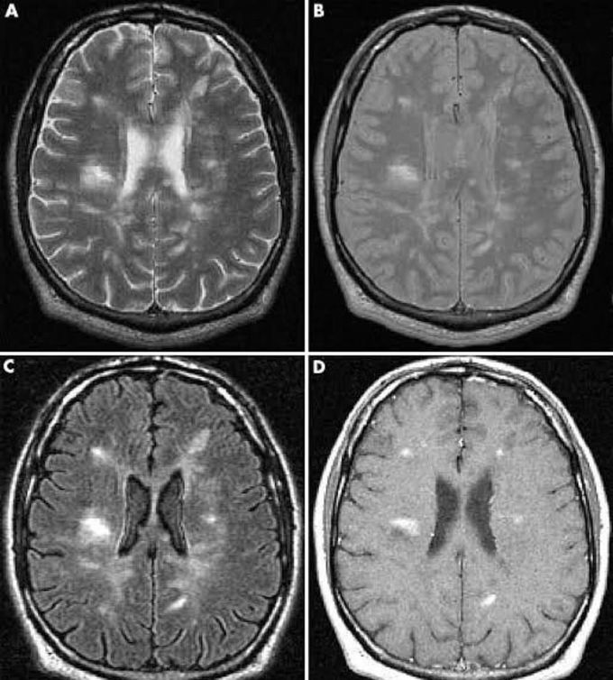 Multiple Sclerosis (MS)