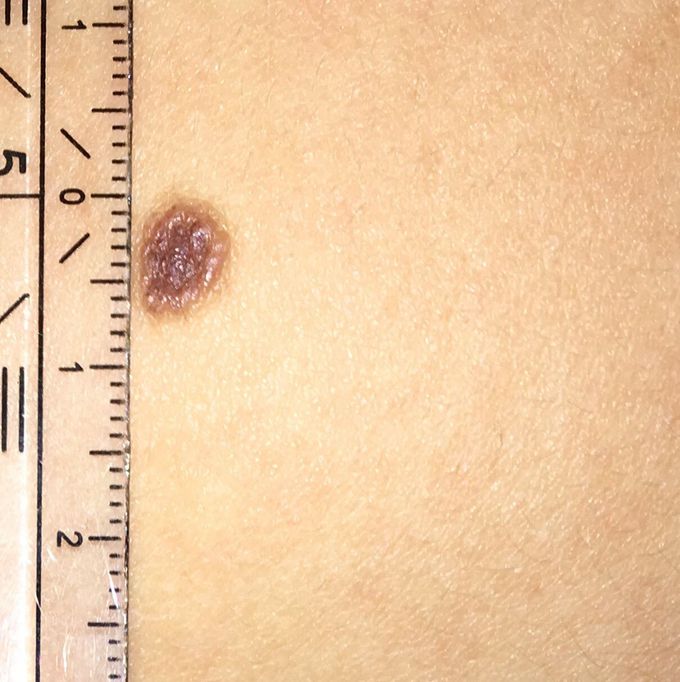 Dermatology Quiz