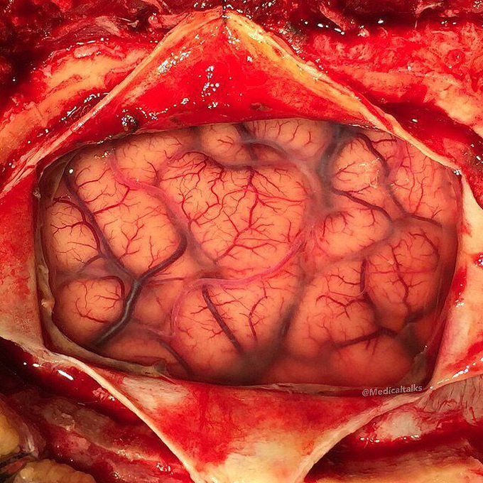 Living human brain during a neurosurgery