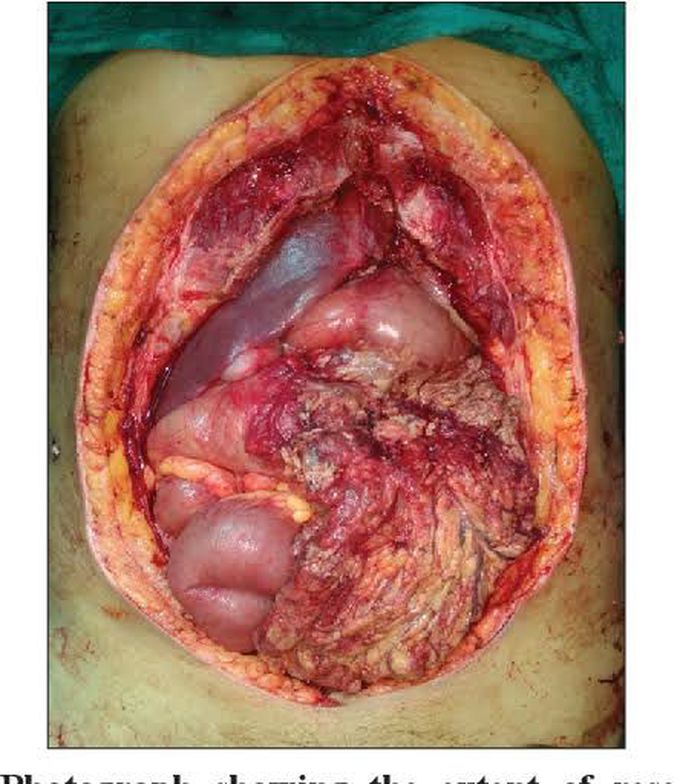 Meleney's ulcer