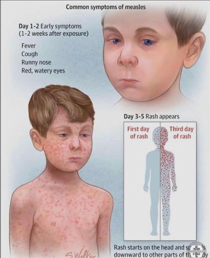 Common symptoms of measles