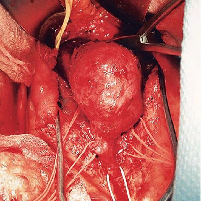 Operation showing a large aneurysm of the abdominal aorta
