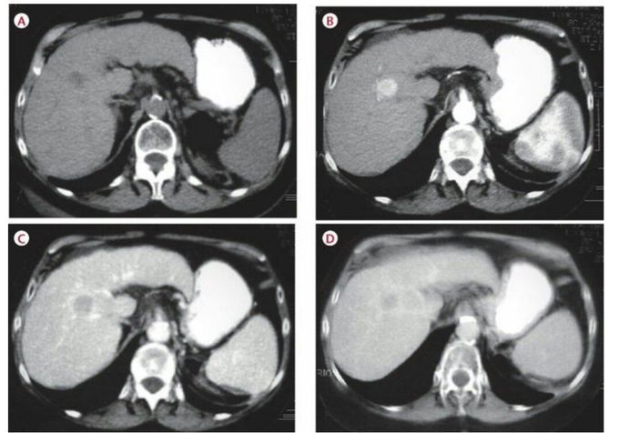 CT of liver