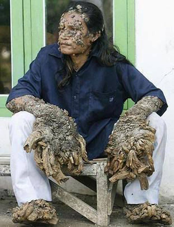 The Indonesian Tree man