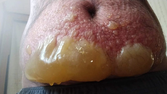 Chemical burns on patient's lower abdomen with blister formation!