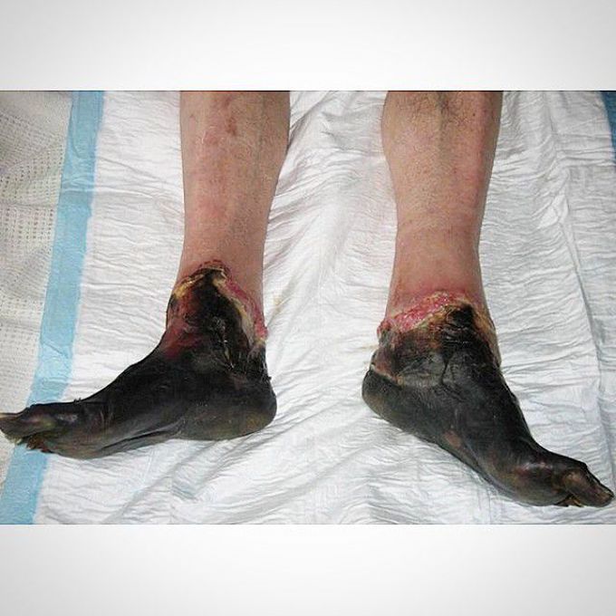 Frostbite feet injuries
