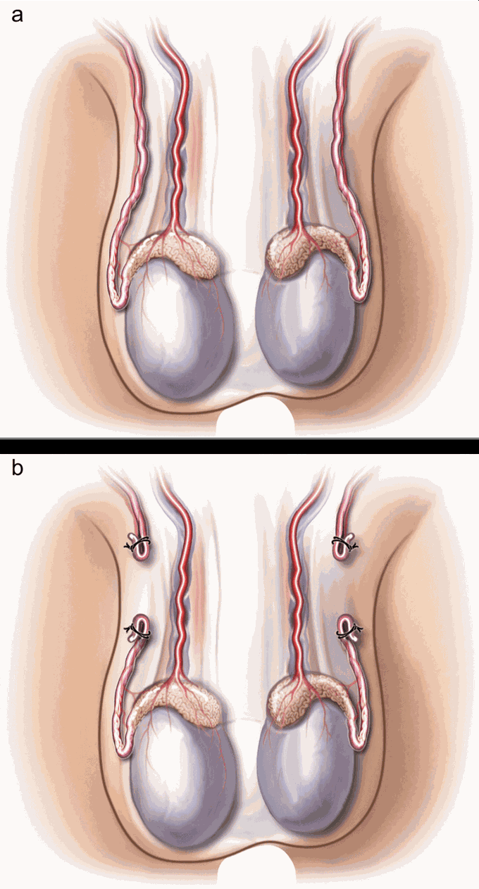 Why it's done? - Vasectomy