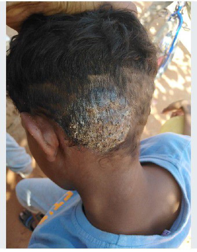 Tinea capitis